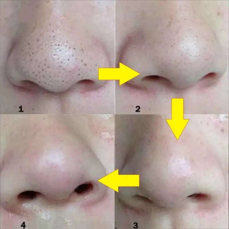 Charcoal Infused Nasal Blackhead Removal Strips